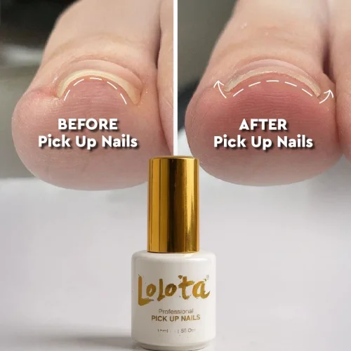 Pick Up Nails Lolota Θεραπεία Είσφρυσης