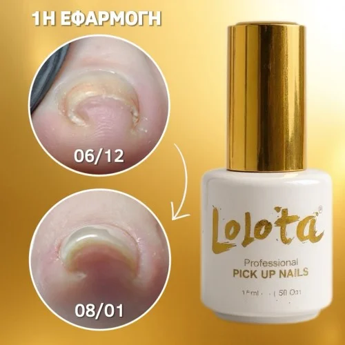 Pick Up Nails Lolota Θεραπεία Είσφρυσης
